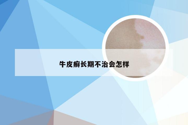 牛皮癣长期不治会怎样