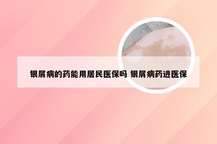 银屑病的药能用居民医保吗 银屑病药进医保