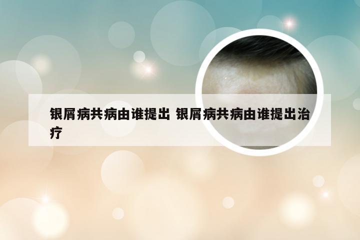 银屑病共病由谁提出 银屑病共病由谁提出治疗