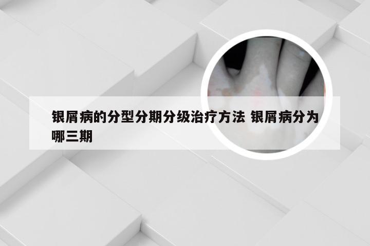 银屑病的分型分期分级治疗方法 银屑病分为哪三期
