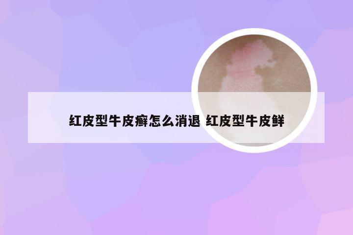 红皮型牛皮癣怎么消退 红皮型牛皮鲜