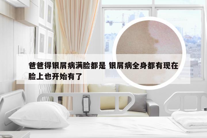 爸爸得银屑病满脸都是 银屑病全身都有现在脸上也开始有了