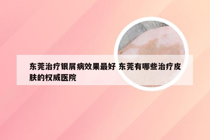 东莞治疗银屑病效果最好 东莞有哪些治疗皮肤的权威医院