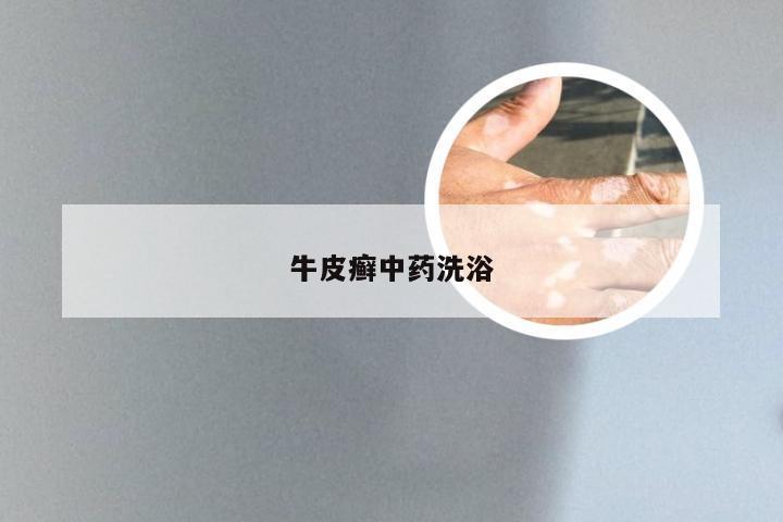 牛皮癣中药洗浴