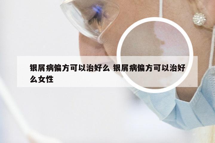 银屑病偏方可以治好么 银屑病偏方可以治好么女性