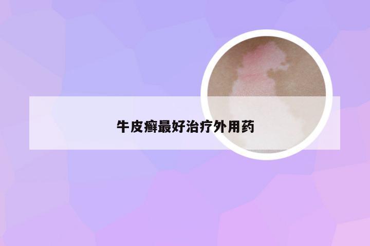 牛皮癣最好治疗外用药