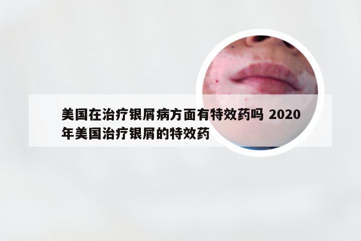 美国在治疗银屑病方面有特效药吗 2020年美国治疗银屑的特效药