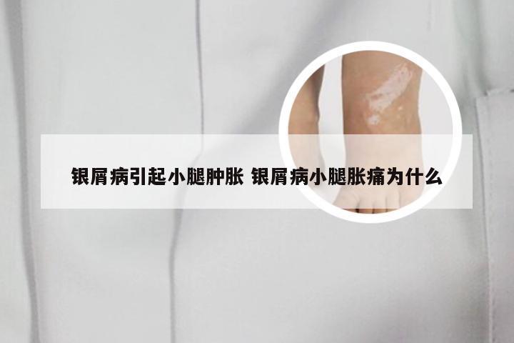 银屑病引起小腿肿胀 银屑病小腿胀痛为什么