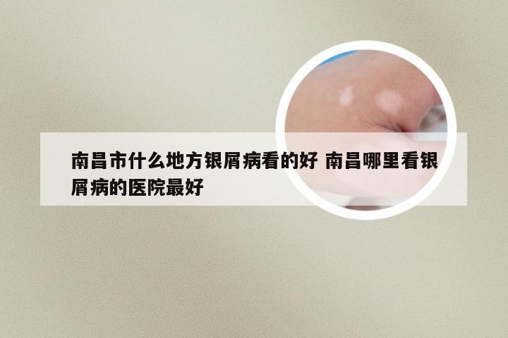 南昌市什么地方银屑病看的好 南昌哪里看银屑病的医院最好