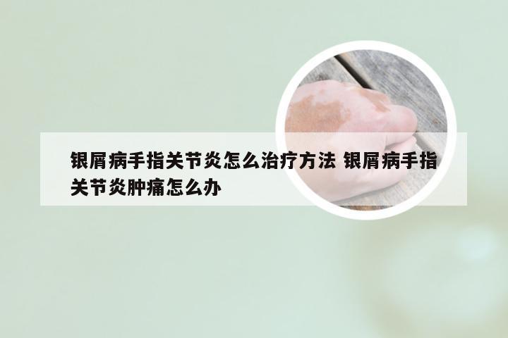 银屑病手指关节炎怎么治疗方法 银屑病手指关节炎肿痛怎么办