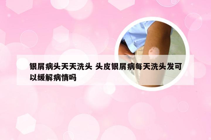 银屑病头天天洗头 头皮银屑病每天洗头发可以缓解病情吗