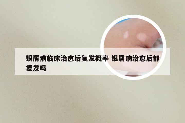 银屑病临床治愈后复发概率 银屑病治愈后都复发吗