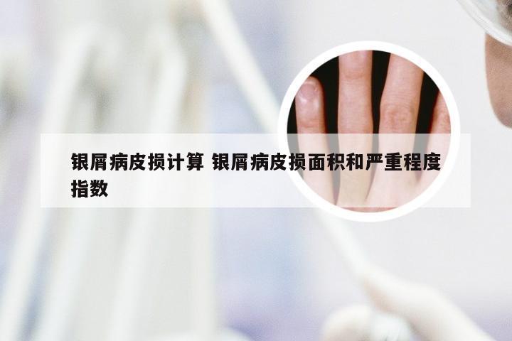 银屑病皮损计算 银屑病皮损面积和严重程度指数
