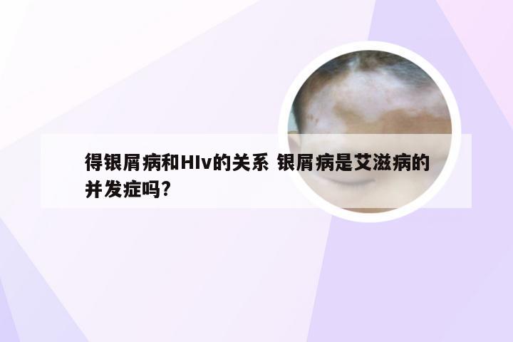 得银屑病和HIv的关系 银屑病是艾滋病的并发症吗?
