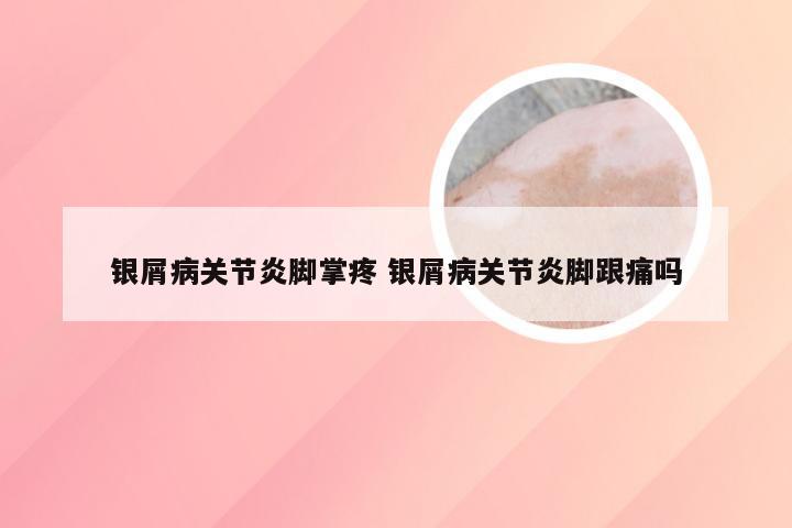 银屑病关节炎脚掌疼 银屑病关节炎脚跟痛吗