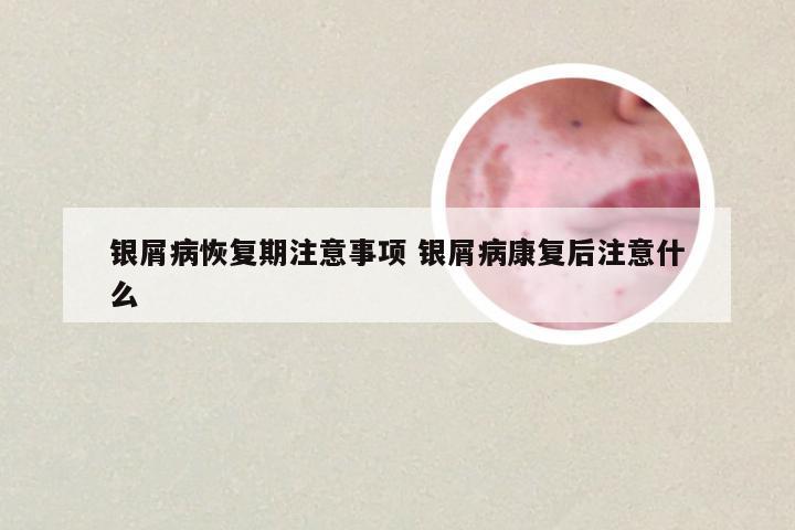 银屑病恢复期注意事项 银屑病康复后注意什么