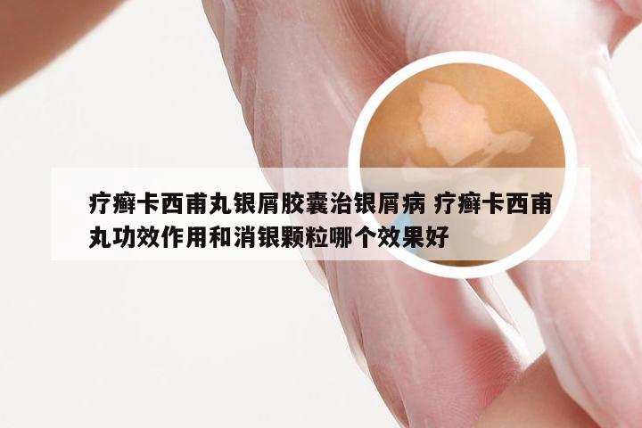 疗癣卡西甫丸银屑胶囊治银屑病 疗癣卡西甫丸功效作用和消银颗粒哪个效果好