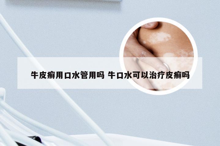 牛皮癣用口水管用吗 牛口水可以治疗皮癣吗