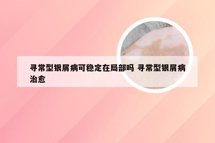 寻常型银屑病可稳定在局部吗 寻常型银屑病治愈