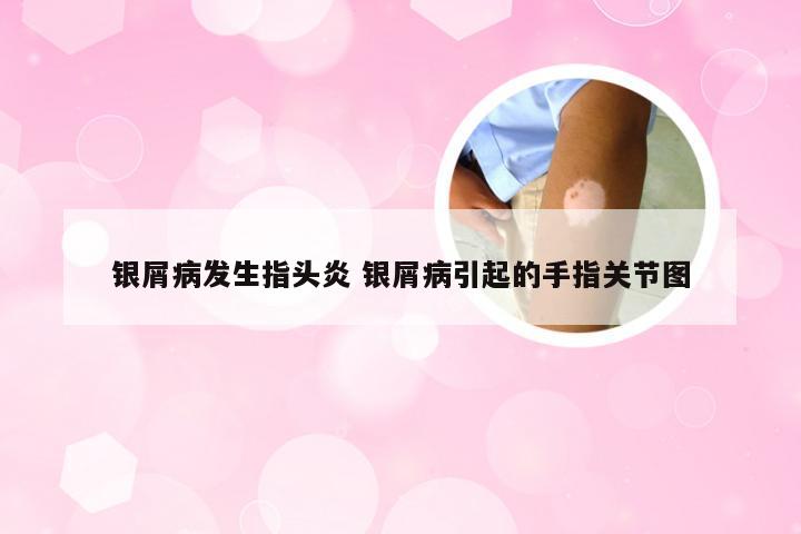 银屑病发生指头炎 银屑病引起的手指关节图