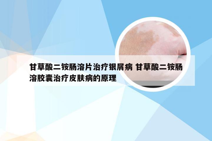 甘草酸二铵肠溶片治疗银屑病 甘草酸二铵肠溶胶囊治疗皮肤病的原理