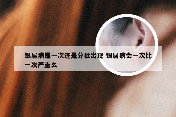 银屑病是一次还是分批出现 银屑病会一次比一次严重么