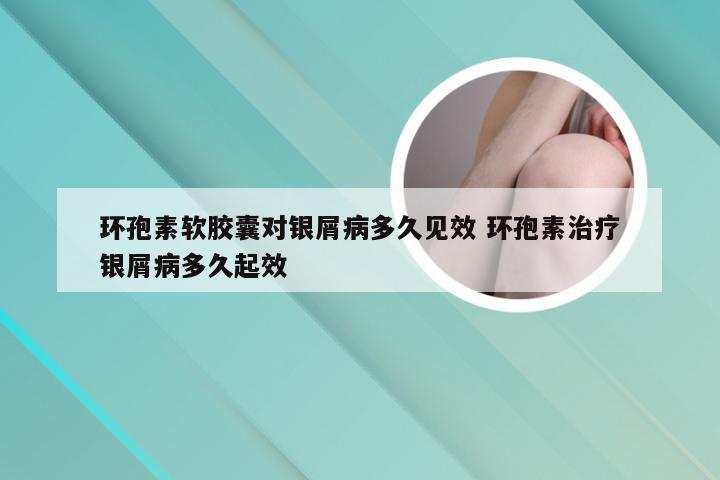 环孢素软胶囊对银屑病多久见效 环孢素治疗银屑病多久起效