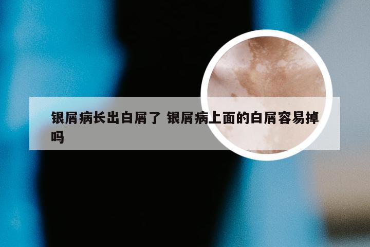 银屑病长出白屑了 银屑病上面的白屑容易掉吗