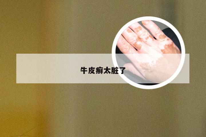 牛皮癣太脏了