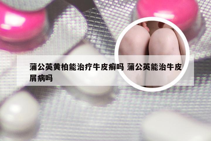 蒲公英黄柏能治疗牛皮癣吗 蒲公英能治牛皮屑病吗