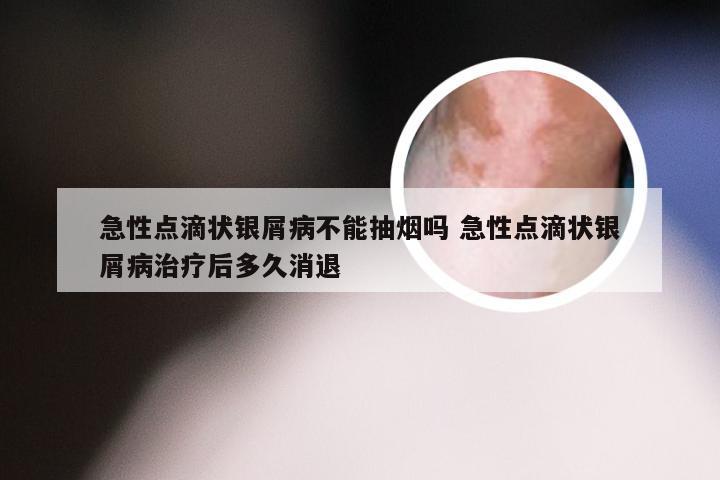 急性点滴状银屑病不能抽烟吗 急性点滴状银屑病治疗后多久消退