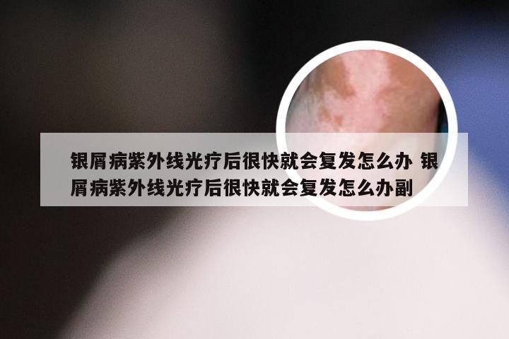 银屑病紫外线光疗后很快就会复发怎么办 银屑病紫外线光疗后很快就会复发怎么办副