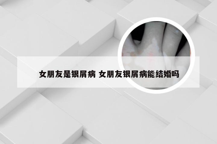 女朋友是银屑病 女朋友银屑病能结婚吗