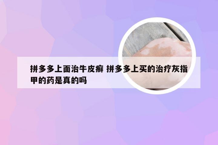 拼多多上面治牛皮癣 拼多多上买的治疗灰指甲的药是真的吗