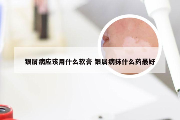 银屑病应该用什么软膏 银屑病抹什么药最好