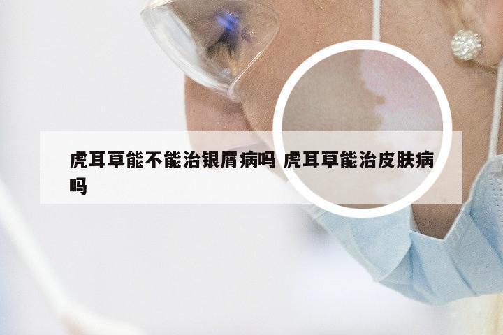 虎耳草能不能治银屑病吗 虎耳草能治皮肤病吗