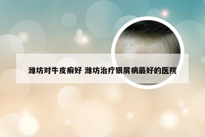 潍坊对牛皮癣好 潍坊治疗银屑病最好的医院