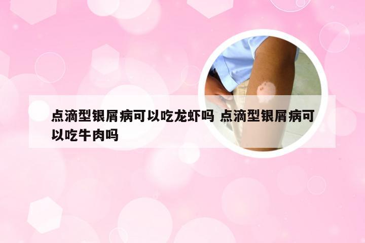 点滴型银屑病可以吃龙虾吗 点滴型银屑病可以吃牛肉吗