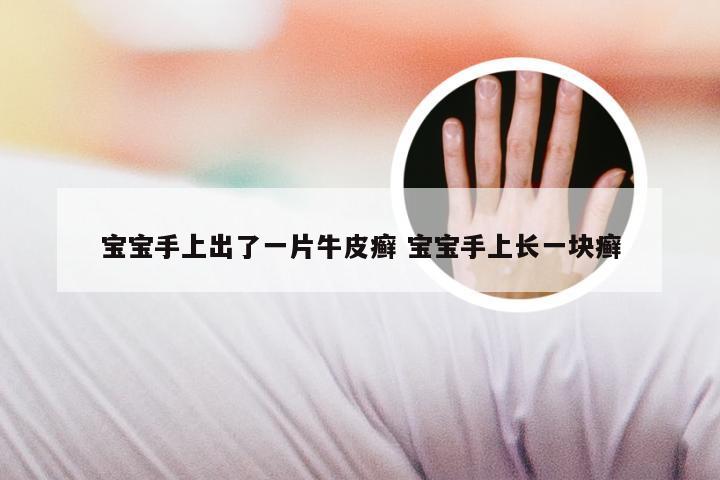 宝宝手上出了一片牛皮癣 宝宝手上长一块癣