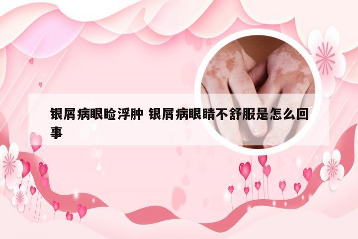 银屑病眼睑浮肿 银屑病眼睛不舒服是怎么回事