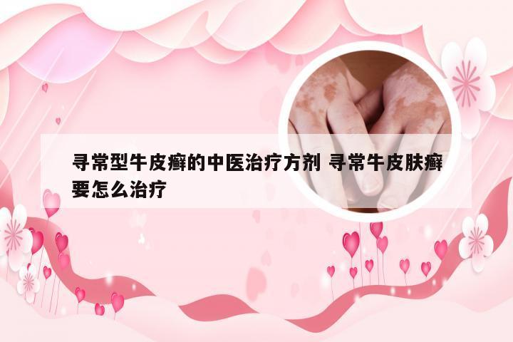 寻常型牛皮癣的中医治疗方剂 寻常牛皮肤癣要怎么治疗
