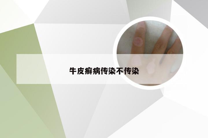 牛皮癣病传染不传染