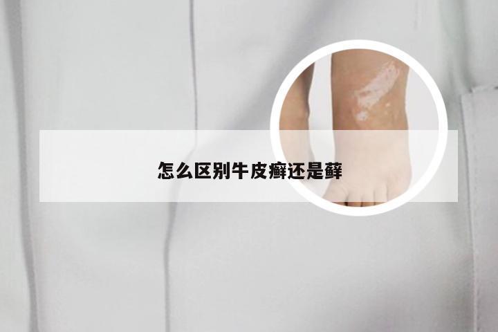 怎么区别牛皮癣还是藓