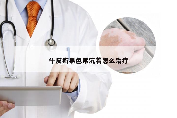 牛皮癣黑色素沉着怎么治疗