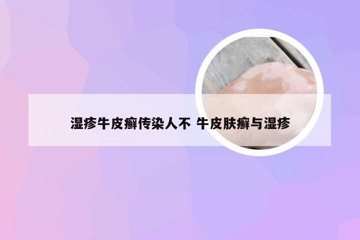 湿疹牛皮癣传染人不 牛皮肤癣与湿疹