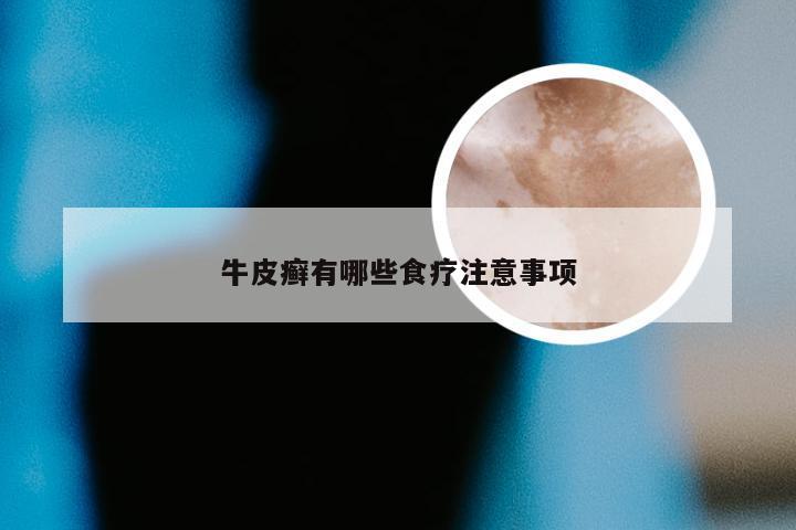 牛皮癣有哪些食疗注意事项