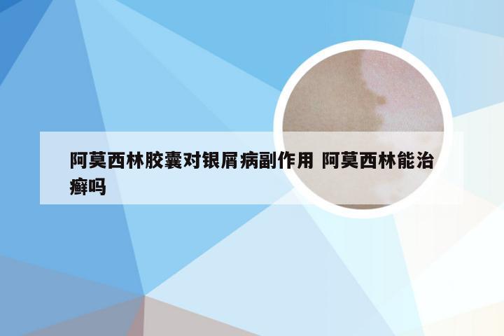 阿莫西林胶囊对银屑病副作用 阿莫西林能治癣吗