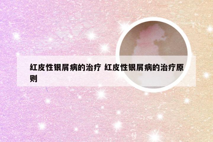 红皮性银屑病的治疗 红皮性银屑病的治疗原则