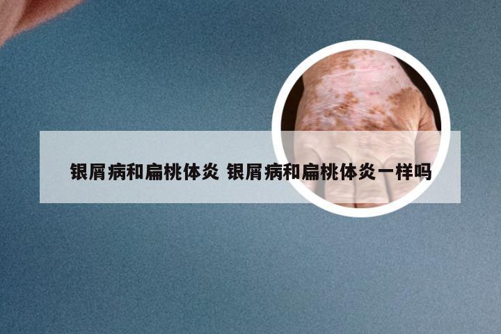 银屑病和扁桃体炎 银屑病和扁桃体炎一样吗