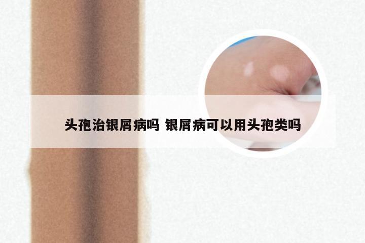 头孢治银屑病吗 银屑病可以用头孢类吗